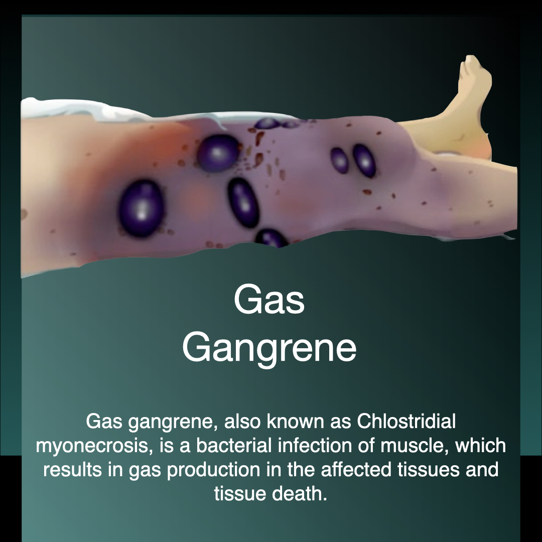 Gas Gangrene